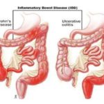 Irritable Bowel Syndrome, Inflammation, and Probiotics